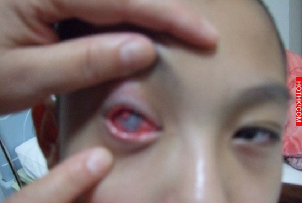可怕！10歲男孩只看了一眼就永久失明！父母千萬別讓孩子玩這個了！ ...