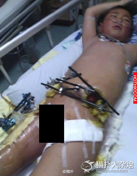 8歲男童遇車禍無錢治 求爸爸安排後事