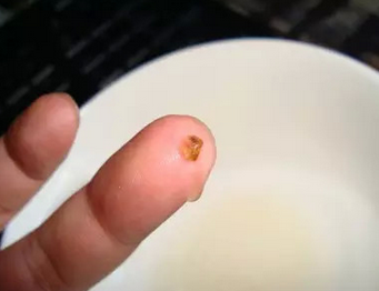 嚇 ！這六類食物吃多了居然會催生「腎結石」！可是這些東西都很好吃阿，花一分鐘看看 ...