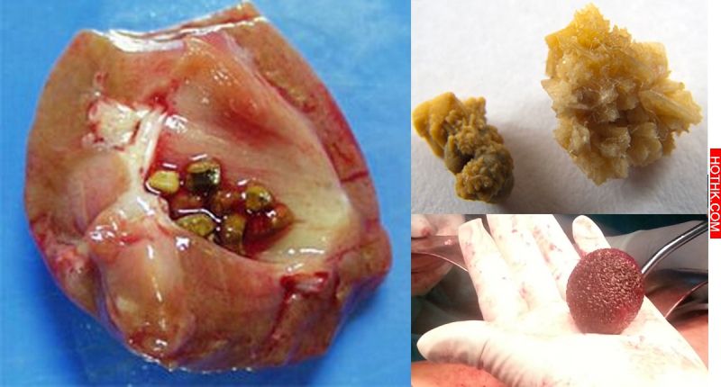 嚇 !這六類食物吃多了居然會催生「腎結石」!可是這些東西都很好吃阿,花一分鐘看看 ... 嚇 !這六類食物吃多了居然會催生「腎結石」!可是這些東西都很好吃阿,花一分鐘看看 ...