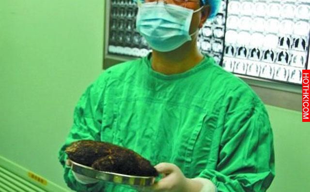 可怕！12歲女孩瘦骨如材、食不下嚥...腹部出現超大硬塊，事後醫生居然在他的胃裡挖到 ...
