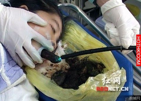 可怕！12歲女孩瘦骨如材、食不下嚥...腹部出現超大硬塊，事後醫生居然在他的胃裡挖到 ...