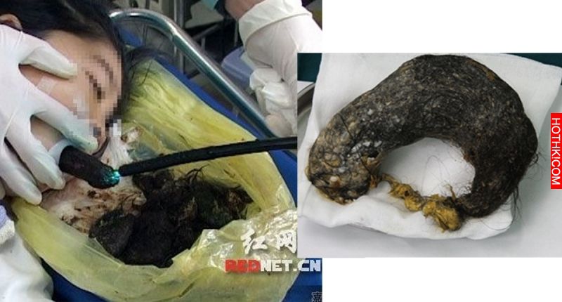 可怕！12歲女孩瘦骨如材、食不下嚥...腹部出現超大硬塊，事後醫生居然在他的胃裡挖到 ...