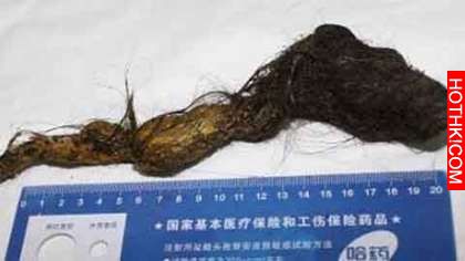 可怕！12歲女孩瘦骨如材、食不下嚥...腹部出現超大硬塊，事後醫生居然在他的胃裡挖到 ...