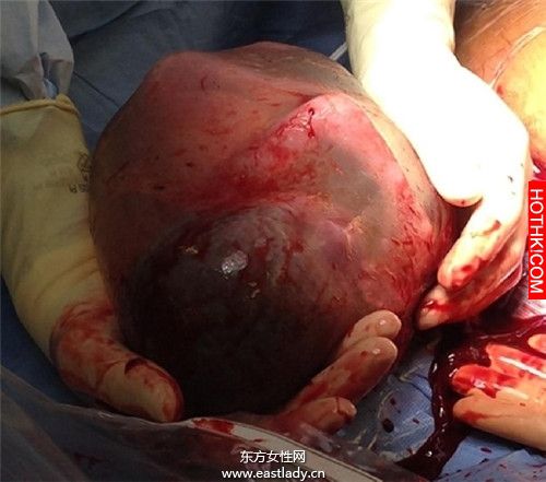 這孩子帶著別人沒有的東西出生，醫生差點慌了手腳！真是醫學奇蹟啊．．． ...