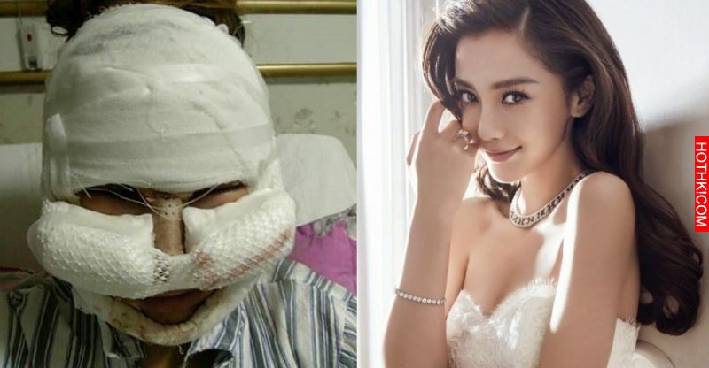 這個女的把臉整成Angelababy！還把整容過程全公開...大家都嚇到了！ ...