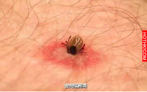 急轉！踏青掃墓小心！這種小蟲現在正活躍！已多次致人死亡！連狗狗都不放過... ...