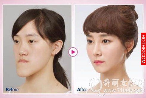 亮瞎眼！中國人跑去韓國整容，醜女出國變仙女回來！家人以為遇到騙子...... ...