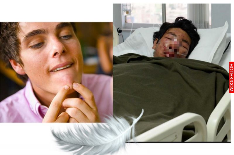 昨晚有個男孩，只是擠一顆痘！就丟了一條命！！這些地方的痘…千萬不能擠！ ...