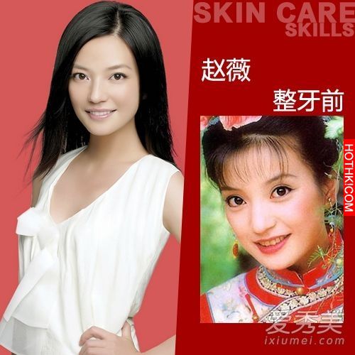 曝光！裴秀智 Baby 楊冪 整牙前後容貌變化驚人！讓人不敢直視... ...