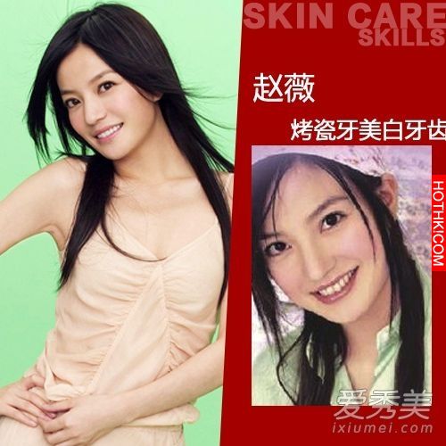 曝光！裴秀智 Baby 楊冪 整牙前後容貌變化驚人！讓人不敢直視... ...