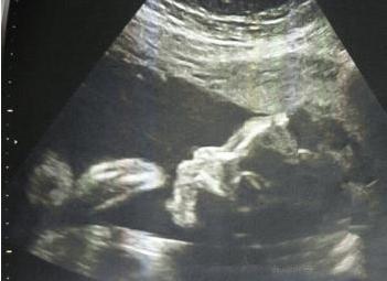 畸形胎兒被流產前，媽媽看到子宮內這一幕後決定生下來！之後竟然... ...