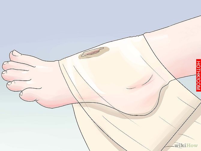 Get Rid of a Scab Step 3.jpg