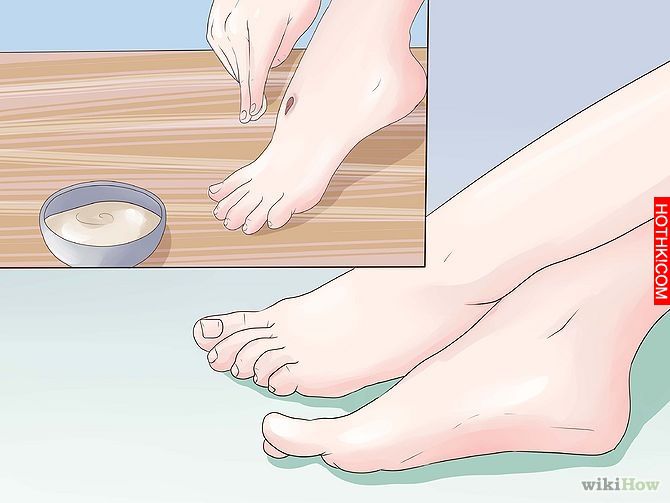 Get Rid of a Scab Step 16.jpg