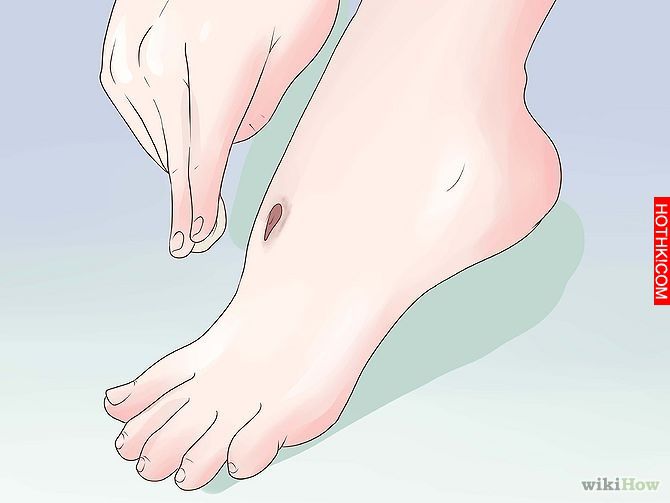 Get Rid of a Scab Step 15.jpg