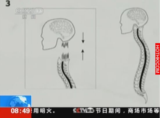 人類首度進行換頭手術！需花36小時，過程生不如死...