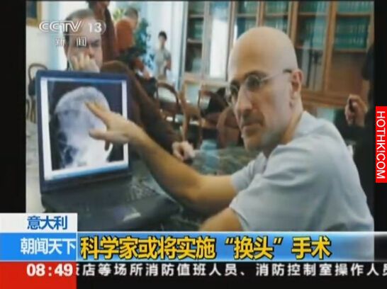 人類首度進行換頭手術！需花36小時，過程生不如死...