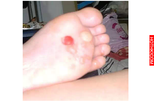 送給大家一個偏方：手脫皮、腳跟痛、手腳抽筋、腳雞眼、手腳皸裂治療！這些方法居然都 ...