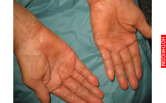 送給大家一個偏方：手脫皮、腳跟痛、手腳抽筋、腳雞眼、手腳皸裂治療！這些方法居然都 ...