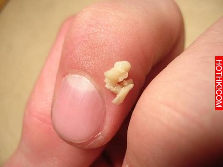 tonsil