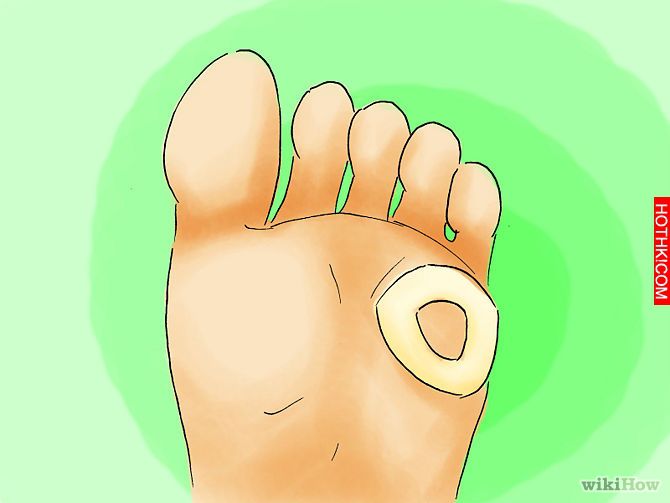 Remove Corns from Your Toes Step 07.jpg