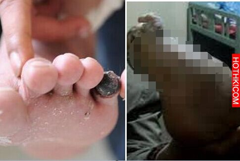 男人長了雞眼，在路邊找個婦人「挖掉」...沒想到傷口越來越黑... ...