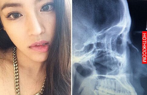 「吳建豪」辣妻被指劈腿又整形！如今她又爆走了，怒PO出赤裸「X光照」顯示真相... ...