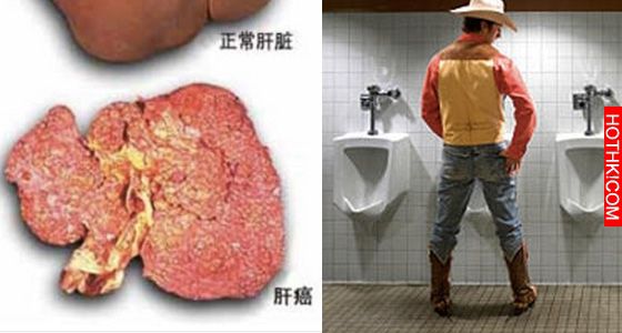 有沒有得肝癌，撒泡尿照照就知道！造福人類的方法，你一定要分享出去！ ...