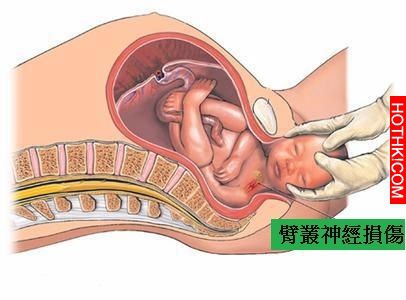 醫生警告產婦：胎兒過大需剖腹！她卻執意要危險的自然產...沒想到小孩生出來竟然造成 ...