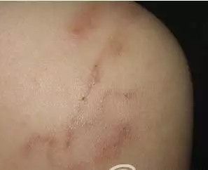 一女子右上腹脹痛不適，醫師檢查後發現肝臟上有巨大的囊腫，一剖開囊腫竟然竄出這種『 ...