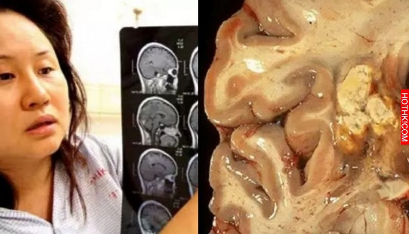 一女子右上腹脹痛不適，醫師檢查後發現肝臟上有巨大的囊腫，一剖開囊腫竟然竄出這種『 ...
