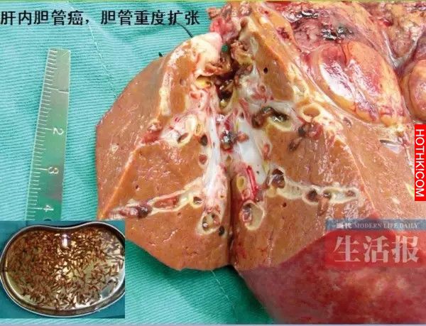 一女子右上腹脹痛不適，醫師檢查後發現肝臟上有巨大的囊腫，一剖開囊腫竟然竄出這種『 ...