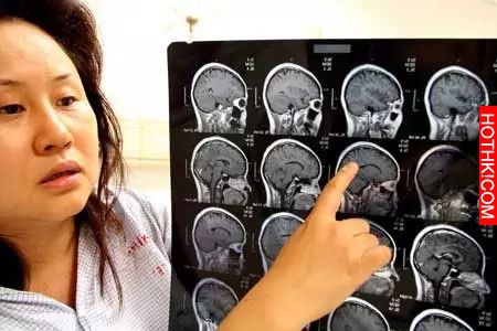 一女子右上腹脹痛不適，醫師檢查後發現肝臟上有巨大的囊腫，一剖開囊腫竟然竄出這種『 ...