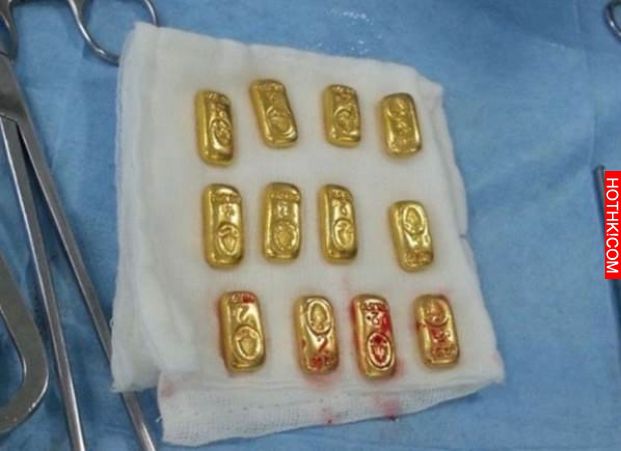 印度富商因吞下瓶蓋要開刀取出，沒想到竟然取出這種『東西』當場把醫生都嚇到傻眼，立 ...