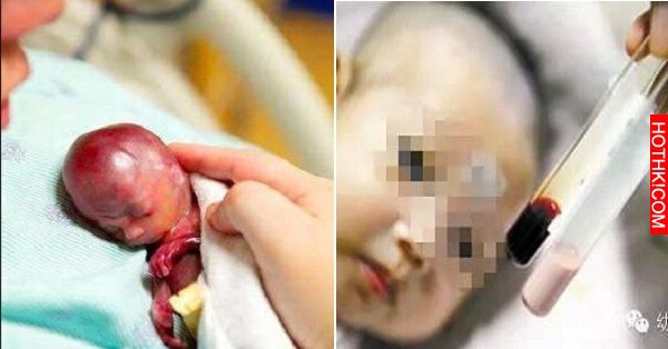 新生寶寶身體竟抽出整袋「白色血液」，竟然是母親懷孕時吃了「這種東西」...醫生的回 ...