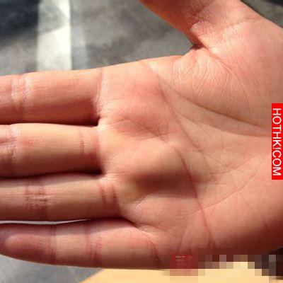 這種腋下腫物，竟是惡性腫瘤一定要留心！