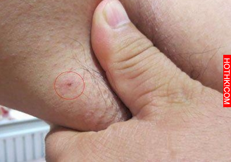 這種腋下腫物，竟是「這種東西」一定要留心！太可怕了