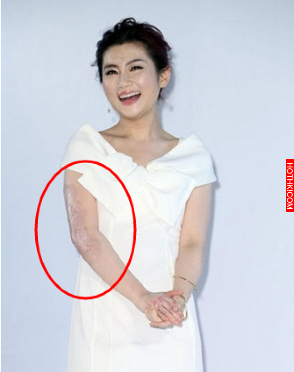 一名網友目擊SELINA上街買東西吃，竟被大嬸搭話直說：夭壽你手都是疤這麼難看，怎麼還 ...