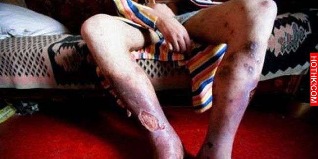 他注射世界上最可怕的「喪屍毒品」後，身體竟然被腐蝕！還出現這些恐怖的慘狀...讓他 ...