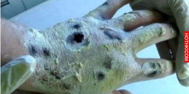 他注射世界上最可怕的「喪屍毒品」後，身體竟然被腐蝕！還出現這些恐怖的慘狀...讓他 ...