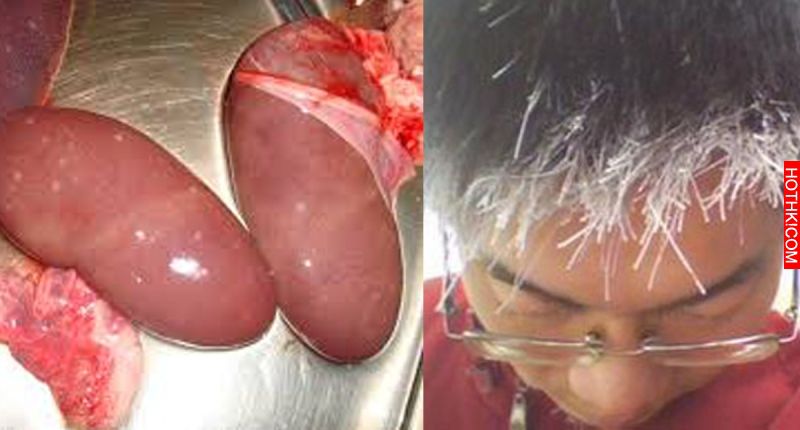 從「頭髮」就能三秒看出你的「腎臟」好不好！「少年白」原來代表著..... 看完後我整個 ...