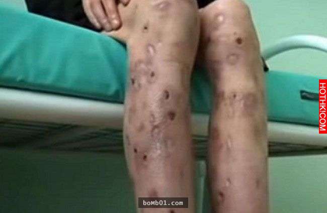 他注射世界上最可怕的「喪屍毒品」後，身體被腐蝕的痛苦讓他後悔到想自殺！ ...