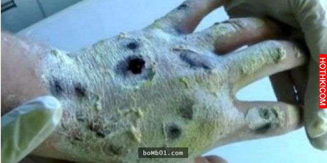 他注射世界上最可怕的「喪屍毒品」後，身體被腐蝕的痛苦讓他後悔到想自殺！ ...