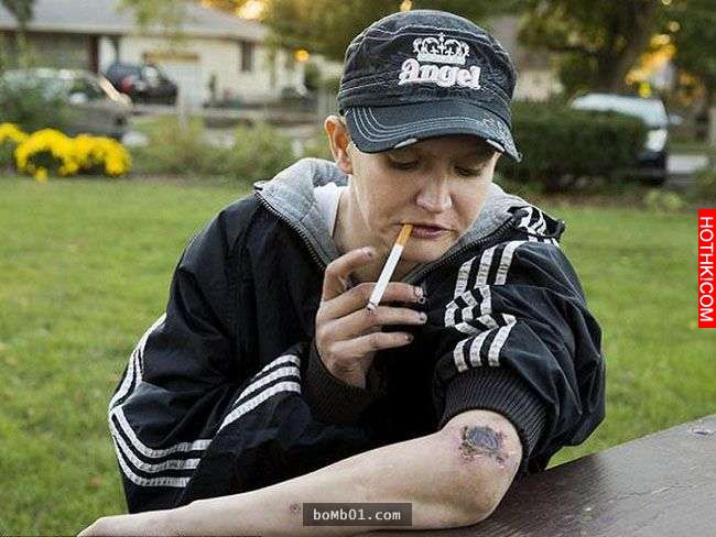 他注射世界上最可怕的「喪屍毒品」後，身體被腐蝕的痛苦讓他後悔到想自殺！ ...