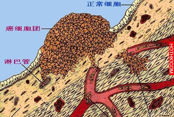 請多喝熱開水：因為癌像感冒一樣普遍： 日本新發現殺癌細胞的方法，原來就是常喝這個 ...