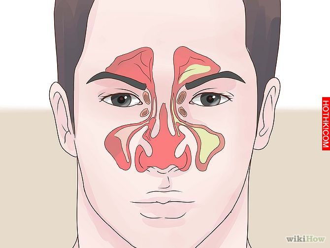 Get Rid of a Stuffy Nose Quickly Step 15