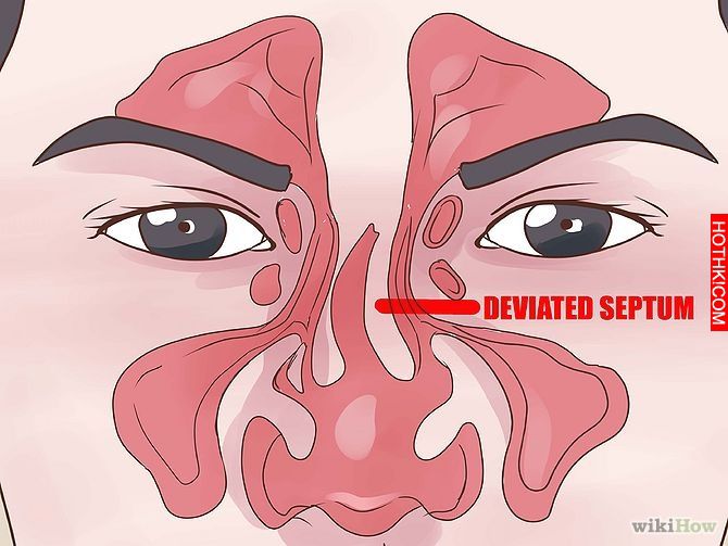 Get Rid of a Stuffy Nose Quickly Step 16