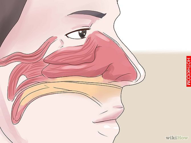 Get Rid of a Stuffy Nose Quickly Step 18