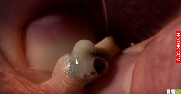 這孩子膝蓋疼痛，醫生從他膝蓋上擠出的「東西」讓在場的人都驚呼！ ...