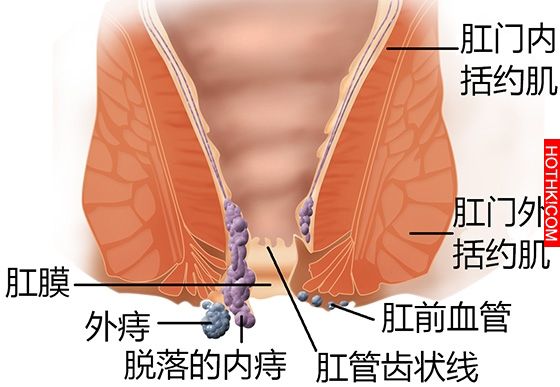 『痔瘡』害我痛苦了十幾年，看了一堆醫生都沒用，結果居然是靠鄰居大媽的一個偏方竟然 ...